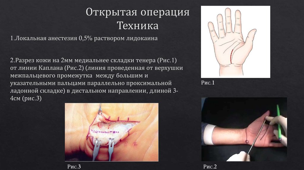 Открытая операция Техника