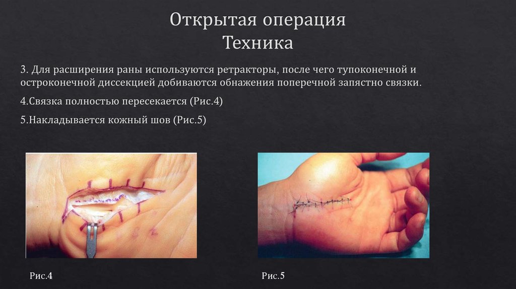 Открытая операция Техника