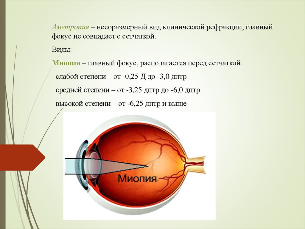 Слабая миопия глаза что. Миопия средней степени астигматизм миопический. Миопия средней степени при дальнозоркости. Миопия 1 степени обоих глаз. Миопия слабой степени.