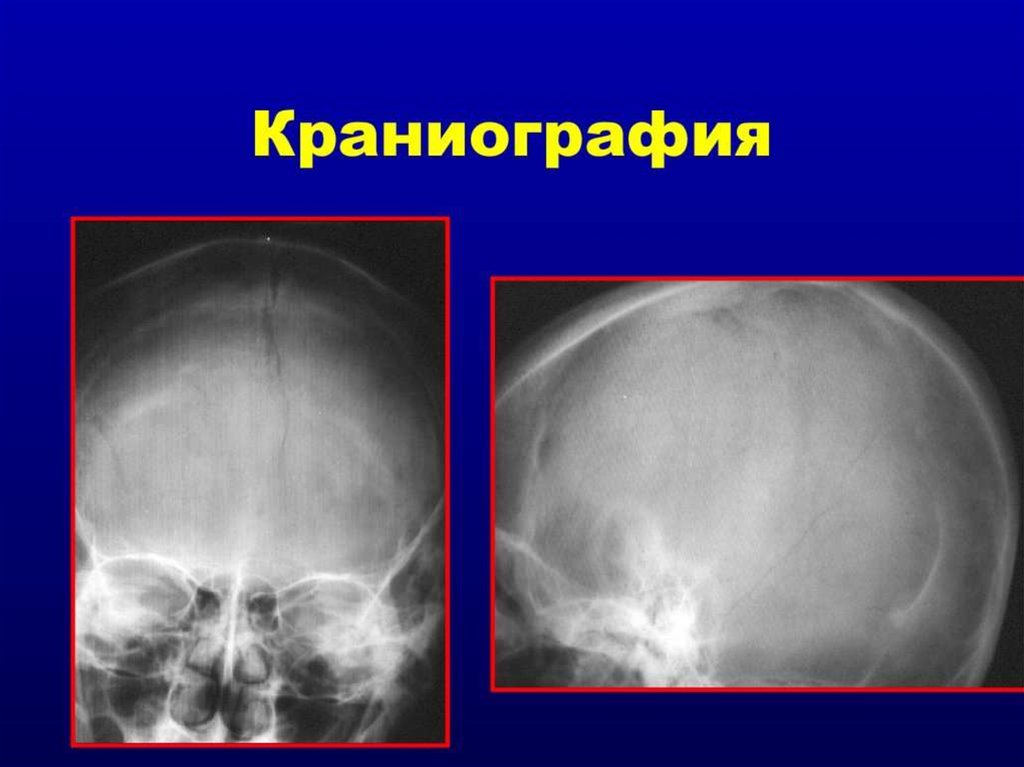 На рентгене черепа усиление сосудистого рисунка