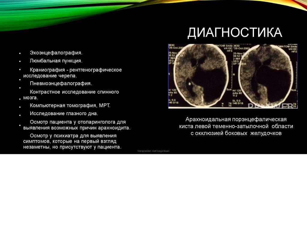 Арахноидит. Симптомы арахноидита. Диагностика. Лечение - online ...