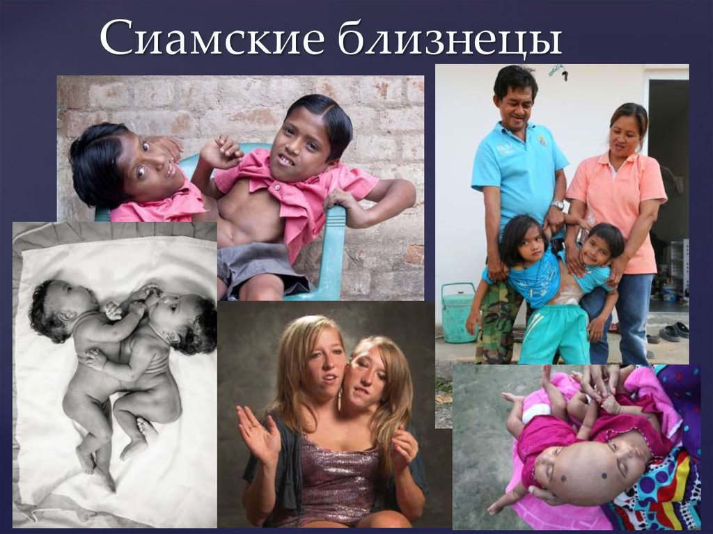 Сиамские близнецы