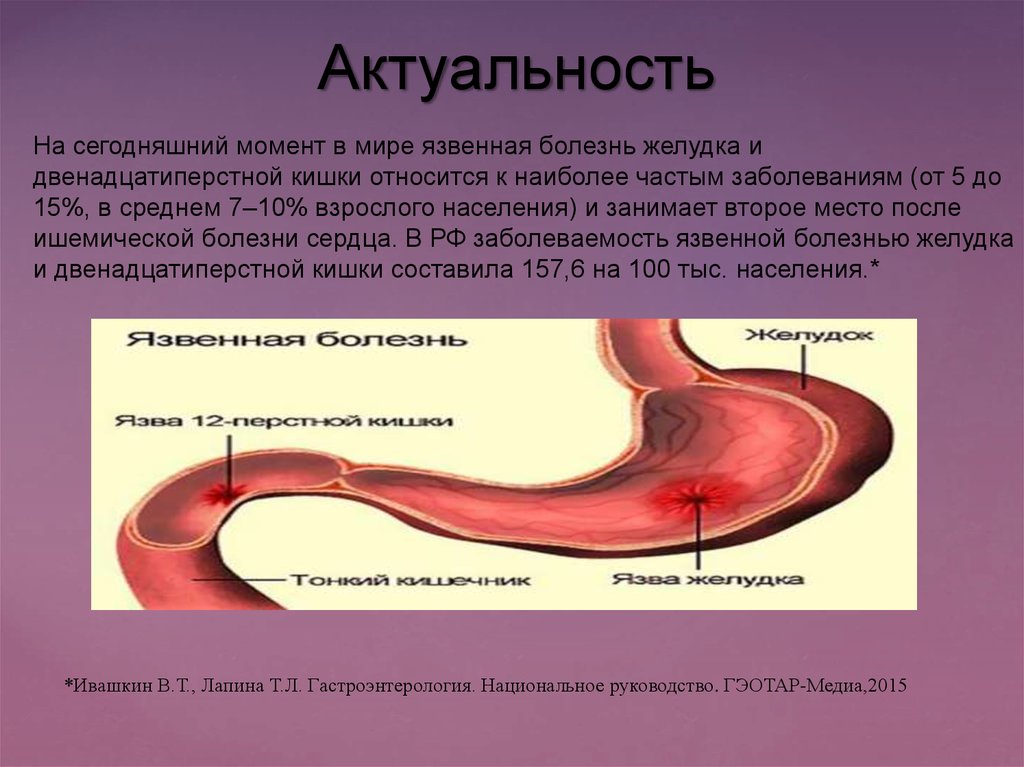 Презентация по язвенной болезни желудка - 98 фото