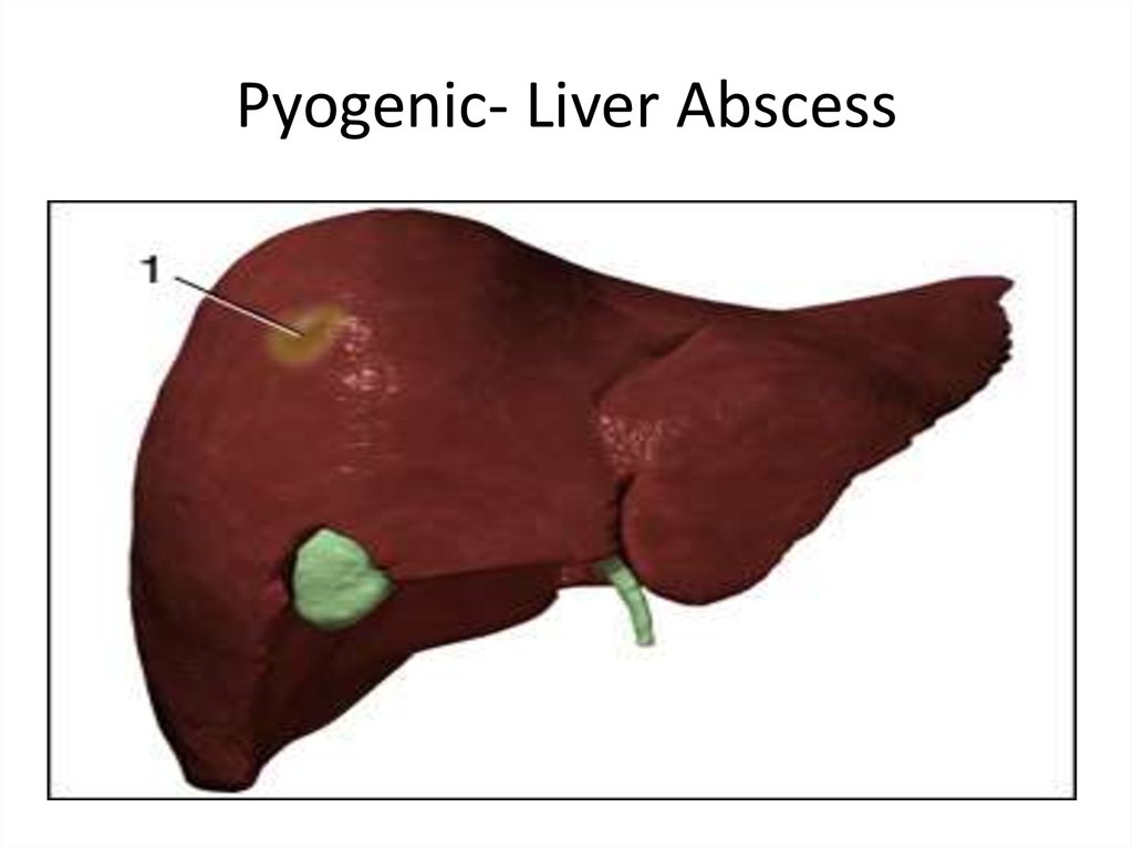Абсцесс печени картинки