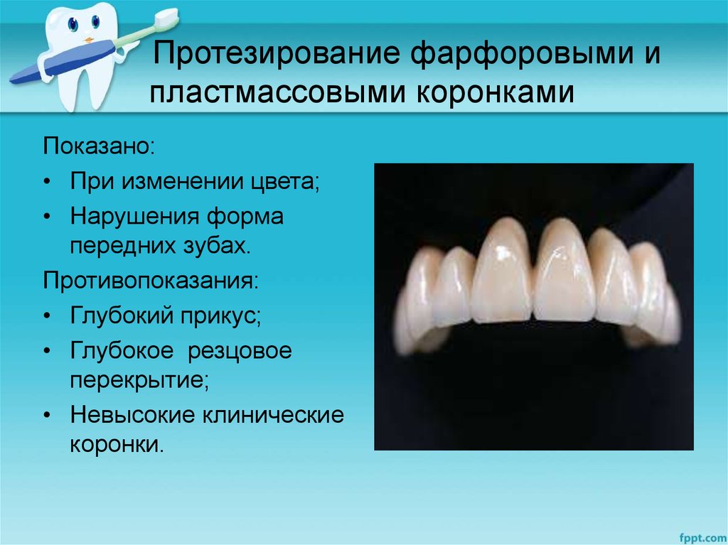 Какую функцию выполняет коронка зуба. Пластмассовые и фарфоровые коронки. Пластмассовые коронки показания. Пластмассовые и фарфоровые зубы. Пластмассовые коронки показания и противопоказания.