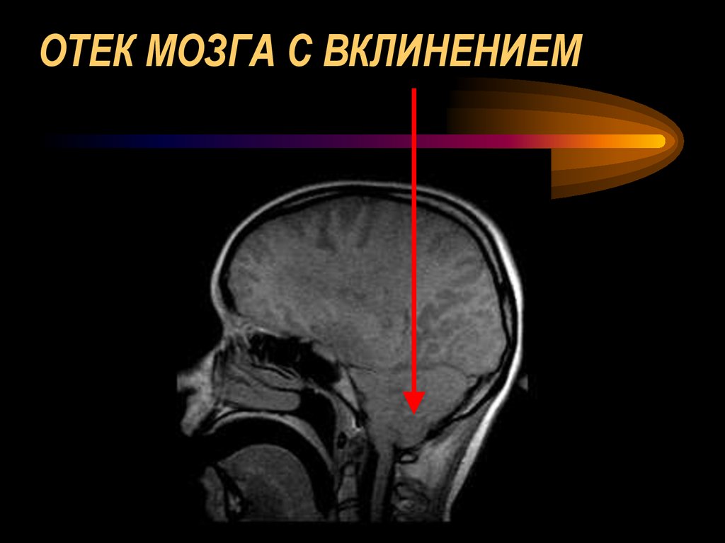 Отеков мозга головы
