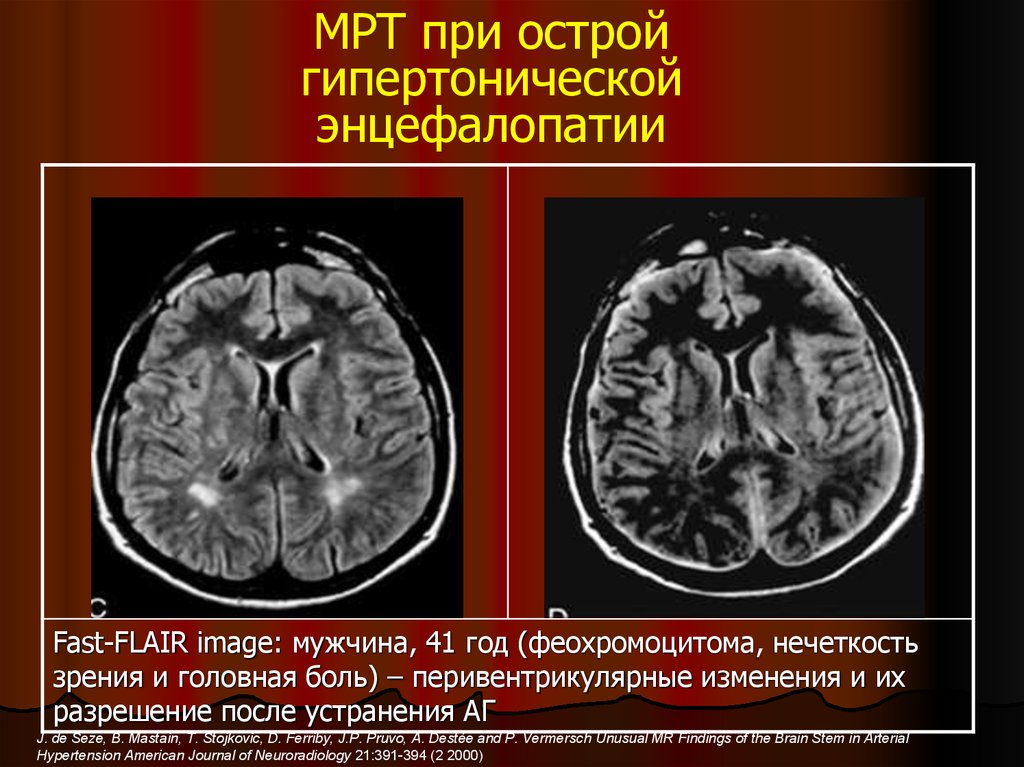 Дисциркуляторной энцефалопатии головного мозга у взрослых что. Гипертензивная энцефалопатия мрт. Острая гипертоническая энцефалопатия мрт. Острая почечная гипертензионная энцефалопатия. Гипертоническая мультиинфарктная энцефалопатия мрт.