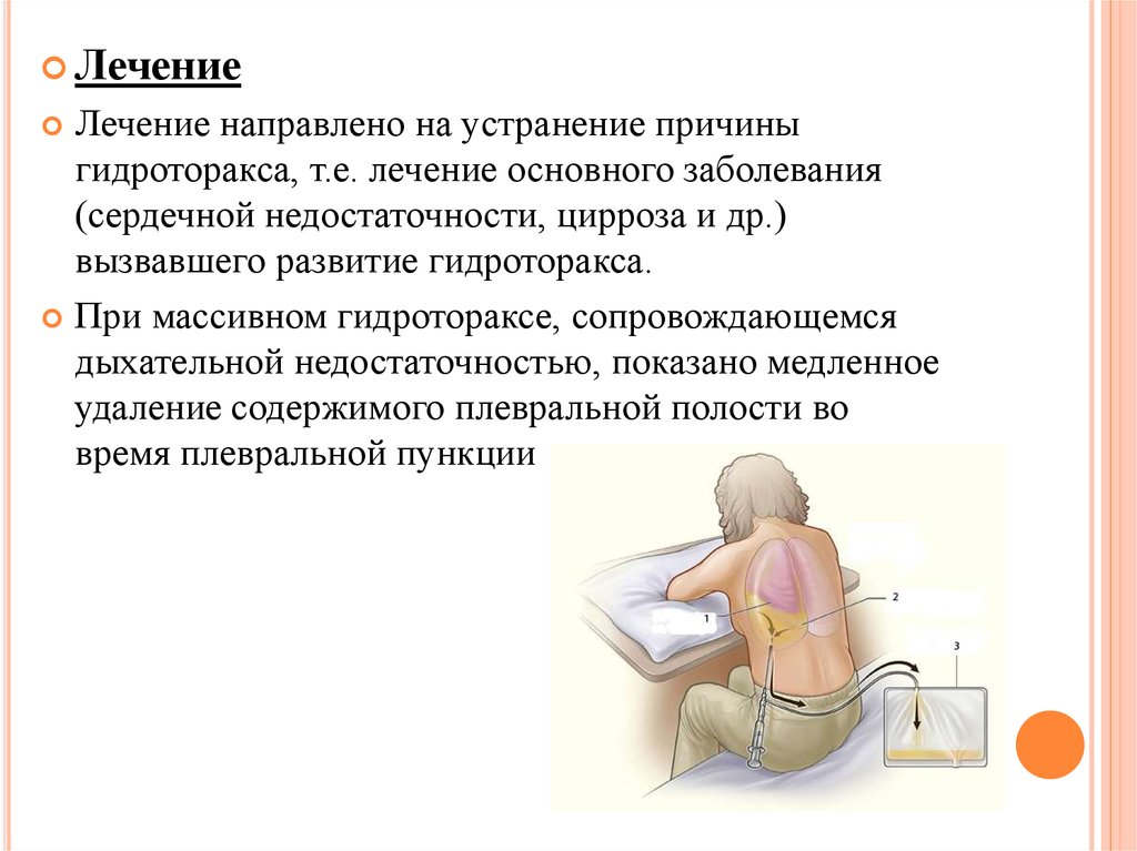 Что такое гидроторакс. Гидроторакс клиническая картина. Гидроторакс при сердечной недостаточности.