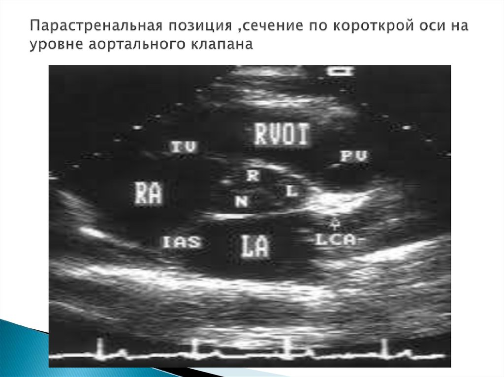 Парастренальная позиция ,сечение по короткрой оси на уровне аортального клапана