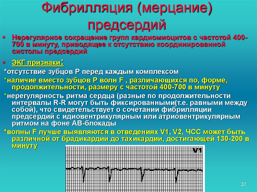 Мерцательная аритмия что это. Трепетание и фибрилляция предсердий на ЭКГ. Пароксизмальная фибрилляция предсердий на ЭКГ. Трепетание предсердий ЭКГ тахисистолия. Мерцательная аритмия фибрилляция предсердий.