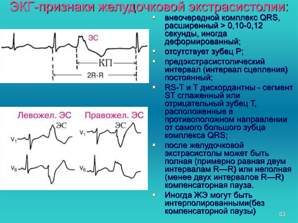 Желудочные экстрасистолы