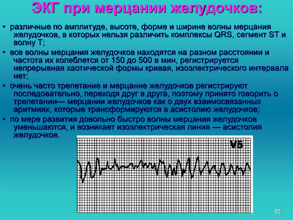 Трепетание желудочков экг фото