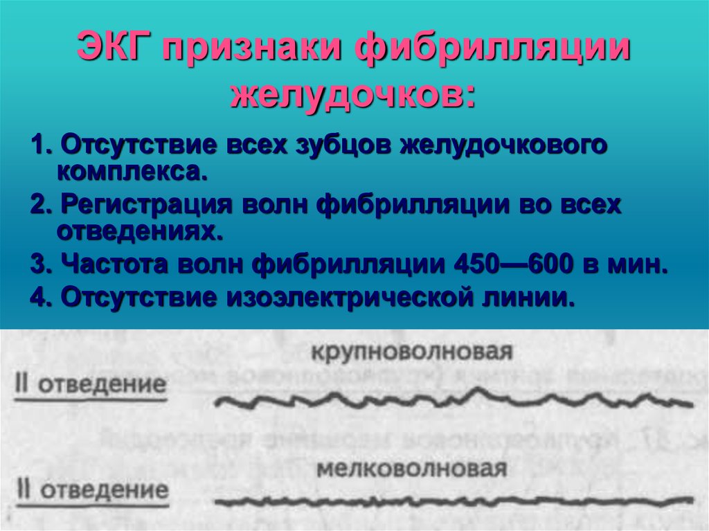 Фибрилляция желудочков на экг фото с заключением