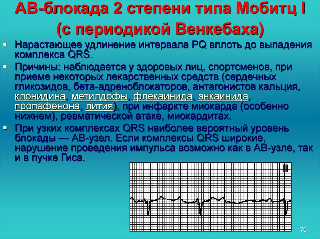 Ав блокада 2 степени