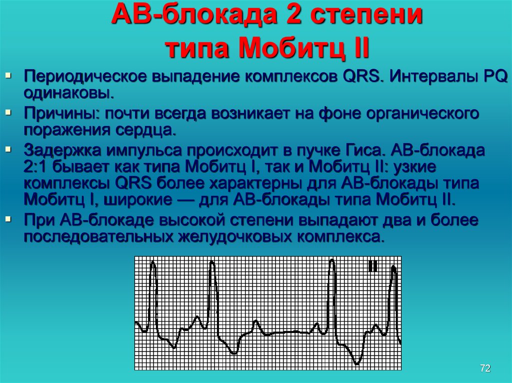 Ав блокада 2 мобитц 1. АВ блокада 2 степени Мобитц 2 на ЭКГ. Аб блокада 2 степени Тип Мобитц 1. Атриовентрикулярная блокада 2 степени 2 типа (Мобитц-2).