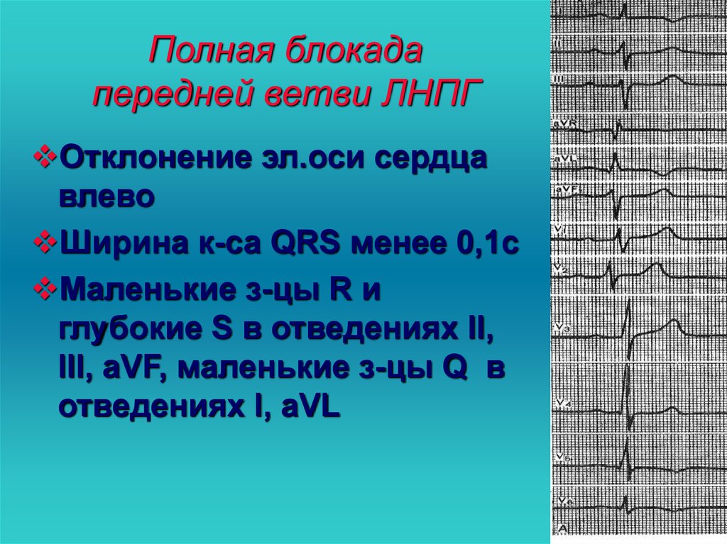 Блокада передней верхней ножки гиса