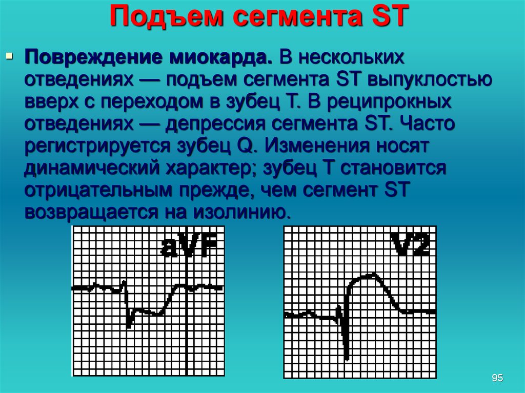 Подъем сегмента. Подъем сегмента St. Горизонтальный подъем сегмента St. Подъем зубца St в грудных отведениях. Подъем сегмента St в грудных отведениях.