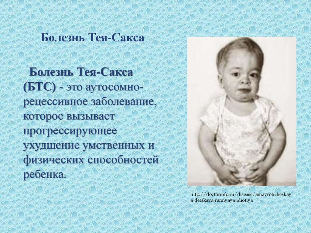 Болезнь тея сакса фото больных