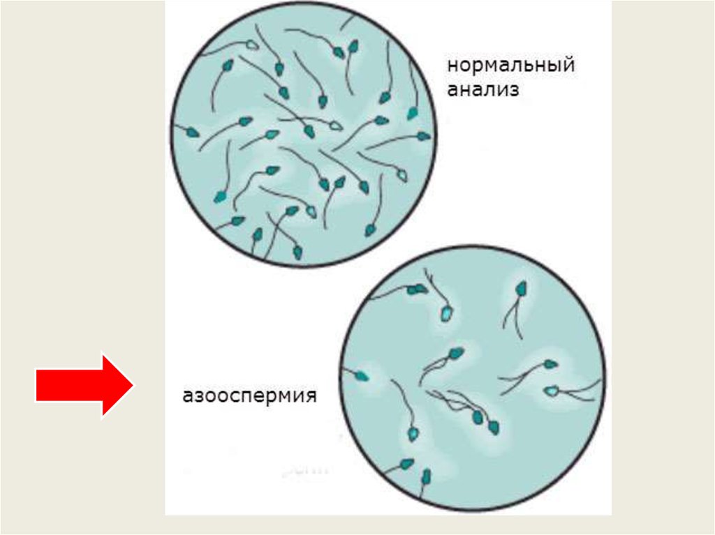 Ест кончину. Азооспермия. Обструктивная азооспермия. Спермограмма при азооспермии. Микроскопическое исследование эякулята.