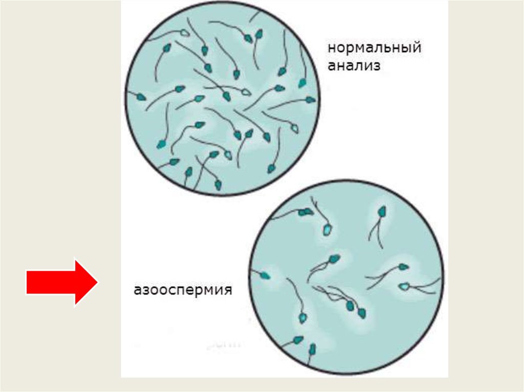 Польза спермы. Азооспермия. Обструктивная азооспермия. Азооспермия спермограмма. Количество сперматозоидов.