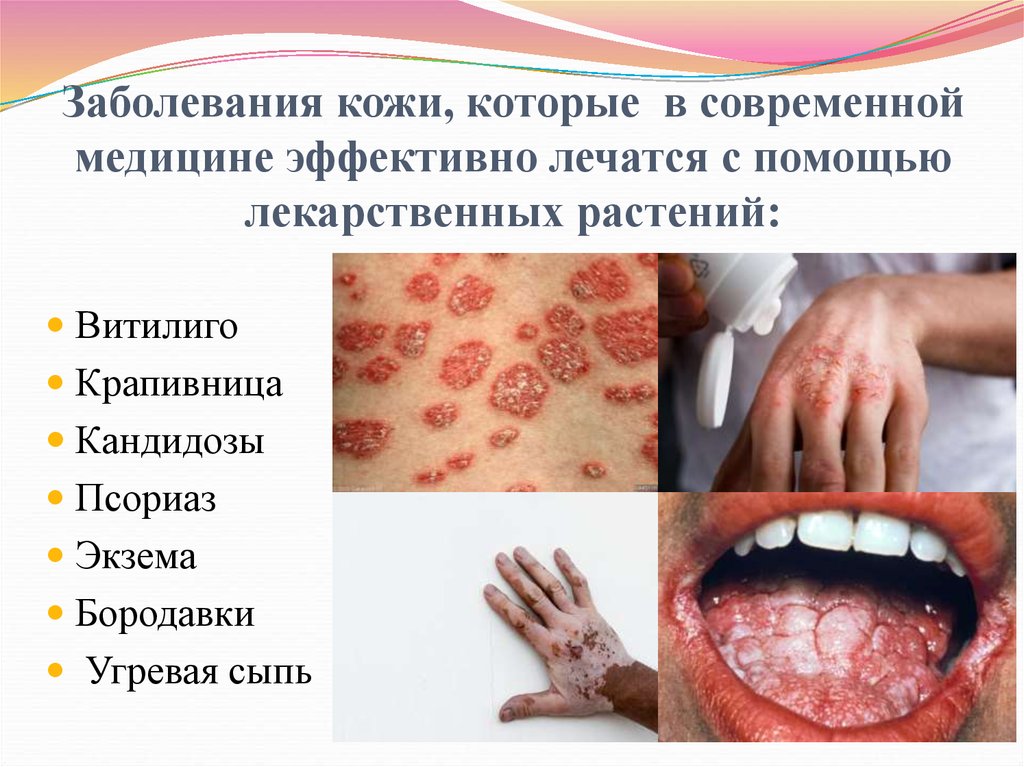 Заболевания кожи, которые в современной медицине эффективно лечатся с помощью лекарственных растений:
