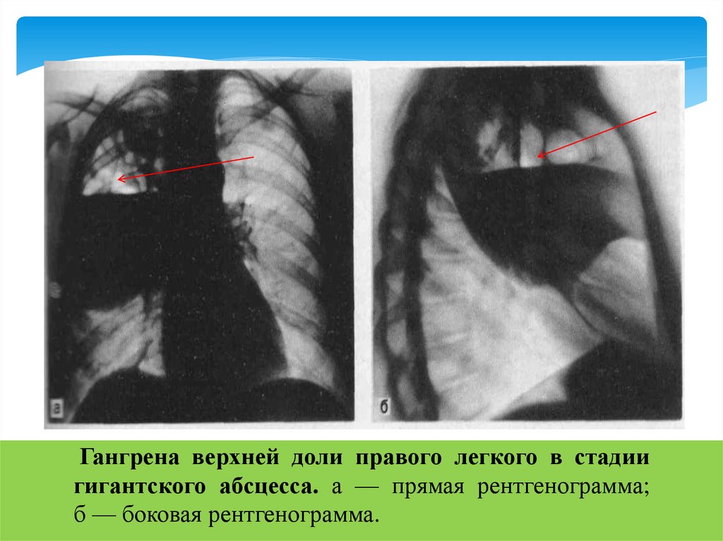 Абсцесс легкого презентация хирургия