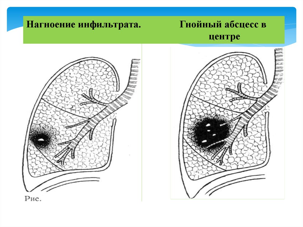 Абсцесс легкого рисунок