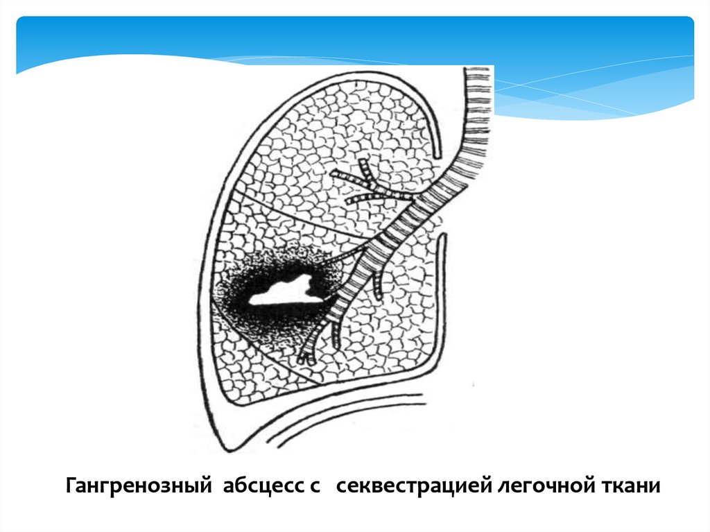 Гангрена легкого рисунок