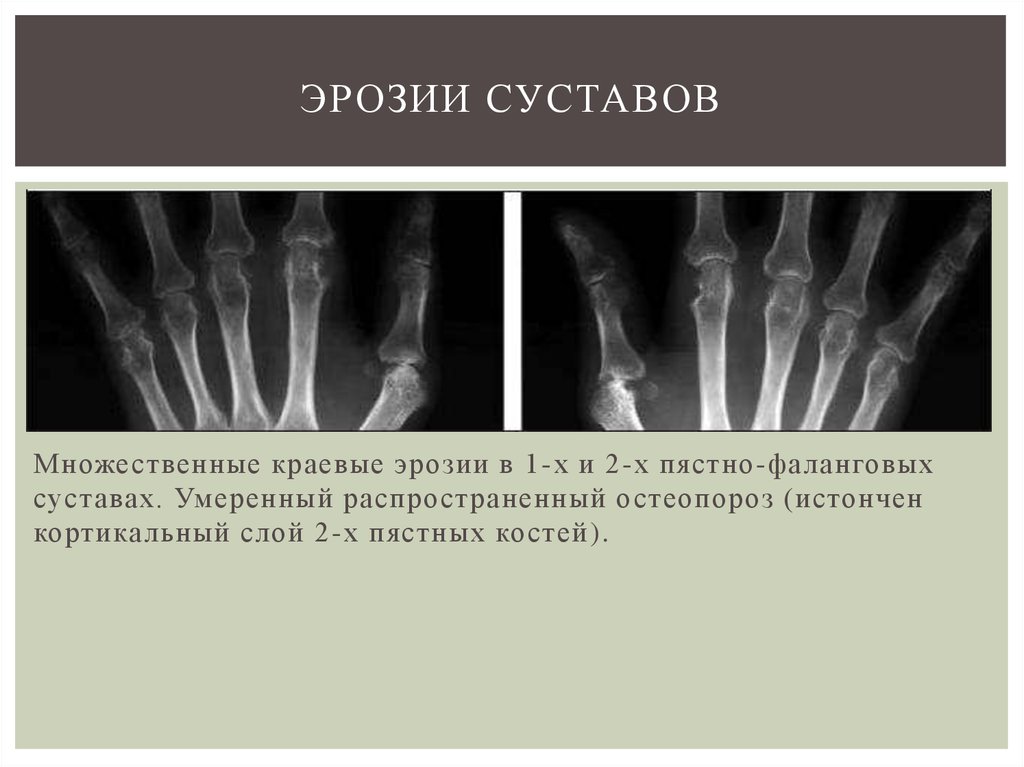 Артрит фаланговых суставов. Ревматоидный артрит рентген эрозии. Ревматоидный артрит кисти рентген. Эрозивный ревматоидный артрит рентген. Эрозии суставных поверхностей при ревматоидном артрите.