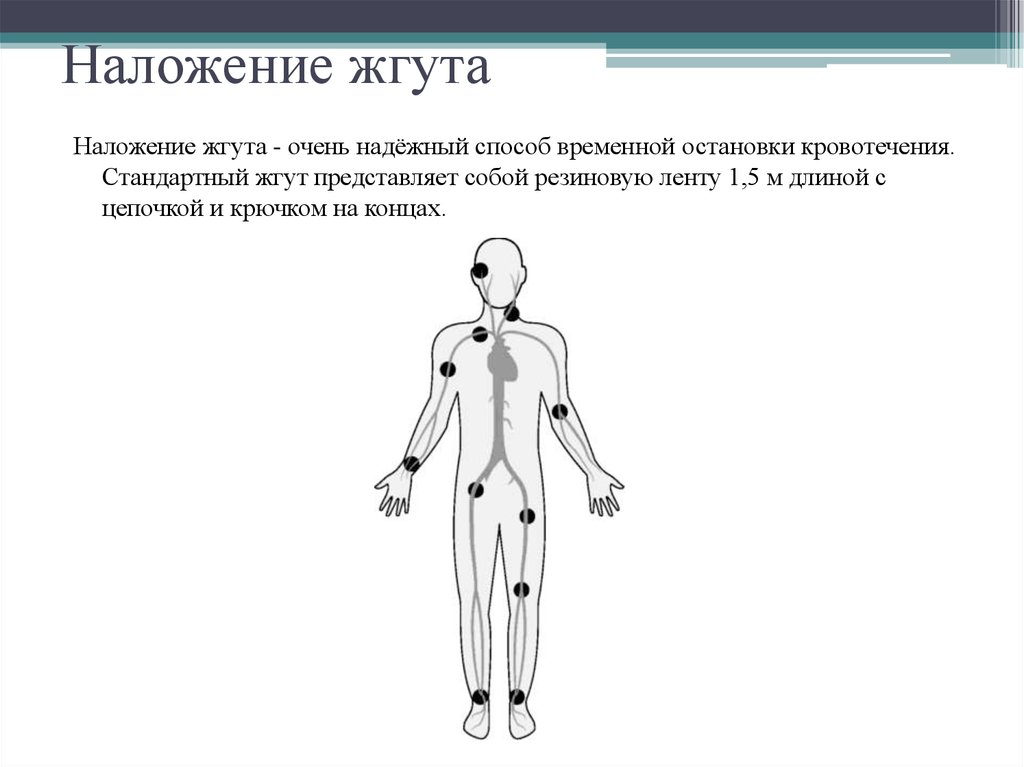 Схема наложения жгута