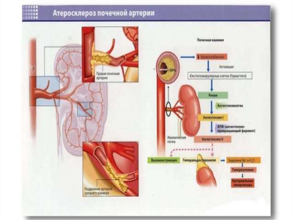 При атеросклерозе поражаются