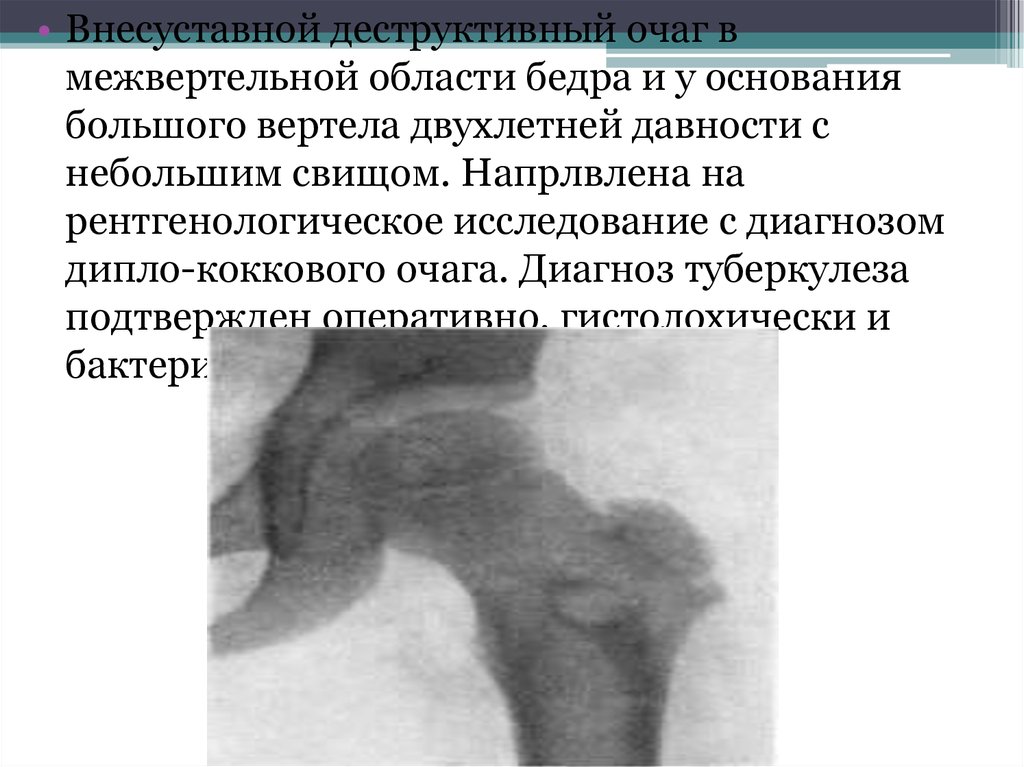 Остеосклеротические очаги в костях