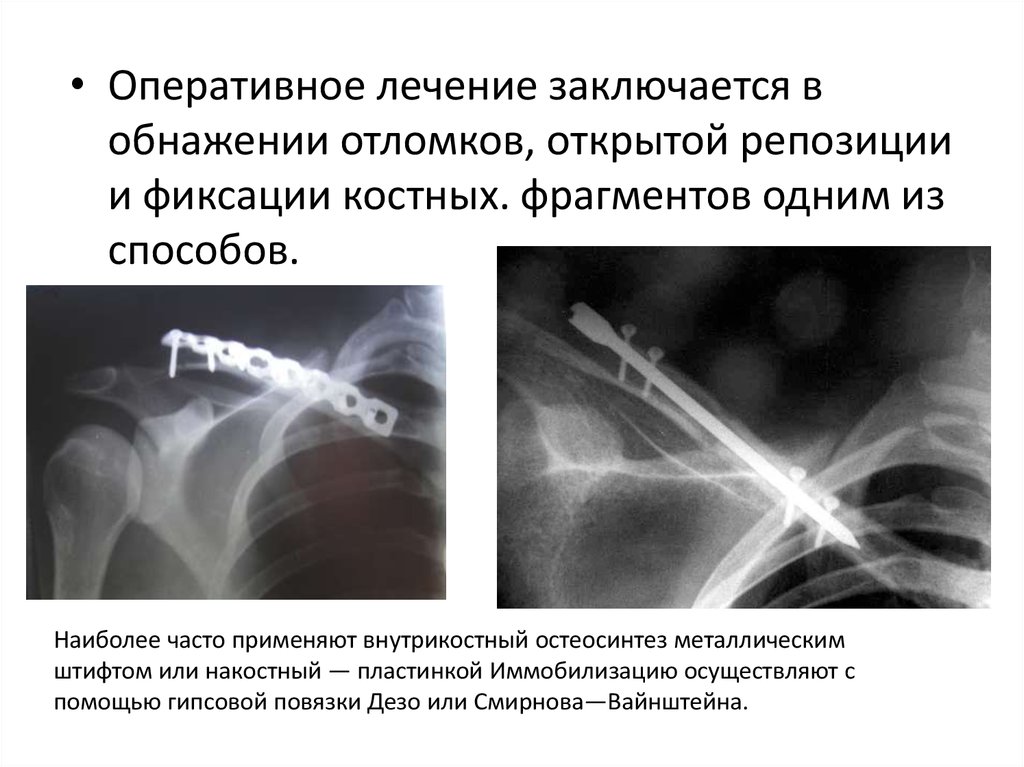 Открытая репозиция костей