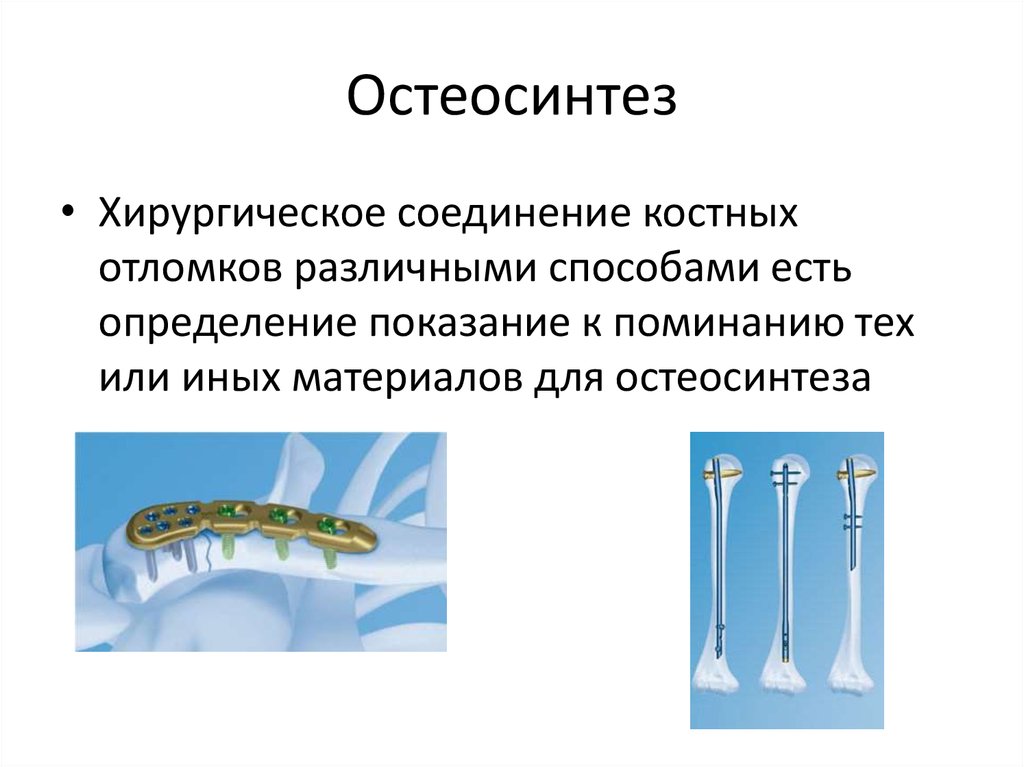 Осложнения остеосинтеза. Способы соединения костных отломков. Остеосинтез классификация.