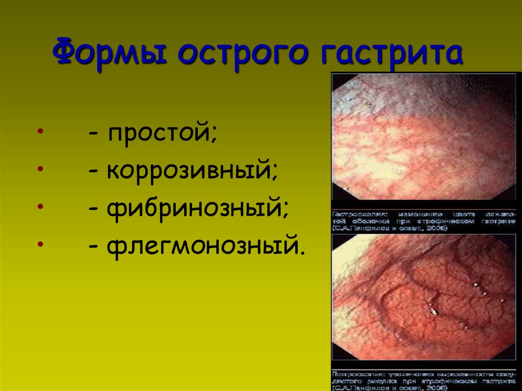 Формы острого гастрита