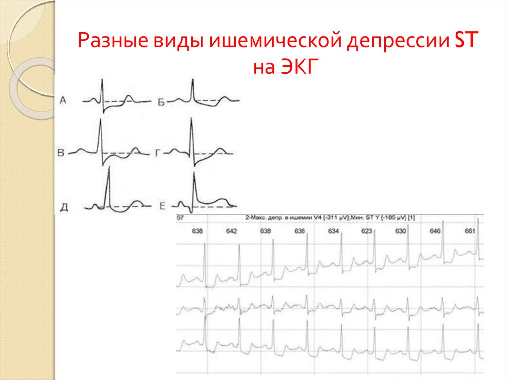 Депрессия st. Депрессия на ЭКГ. Виды депрессии St на ЭКГ. Депрессия q на ЭКГ. Ишемическая депрессия.