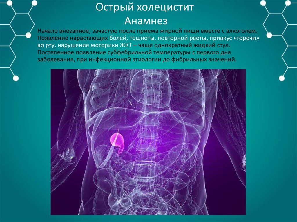 Холецистит мкб. Острый холецистит анамнез. Холецистит анамнез заболевания. Анамнез при остром холецистите. Острый живот.