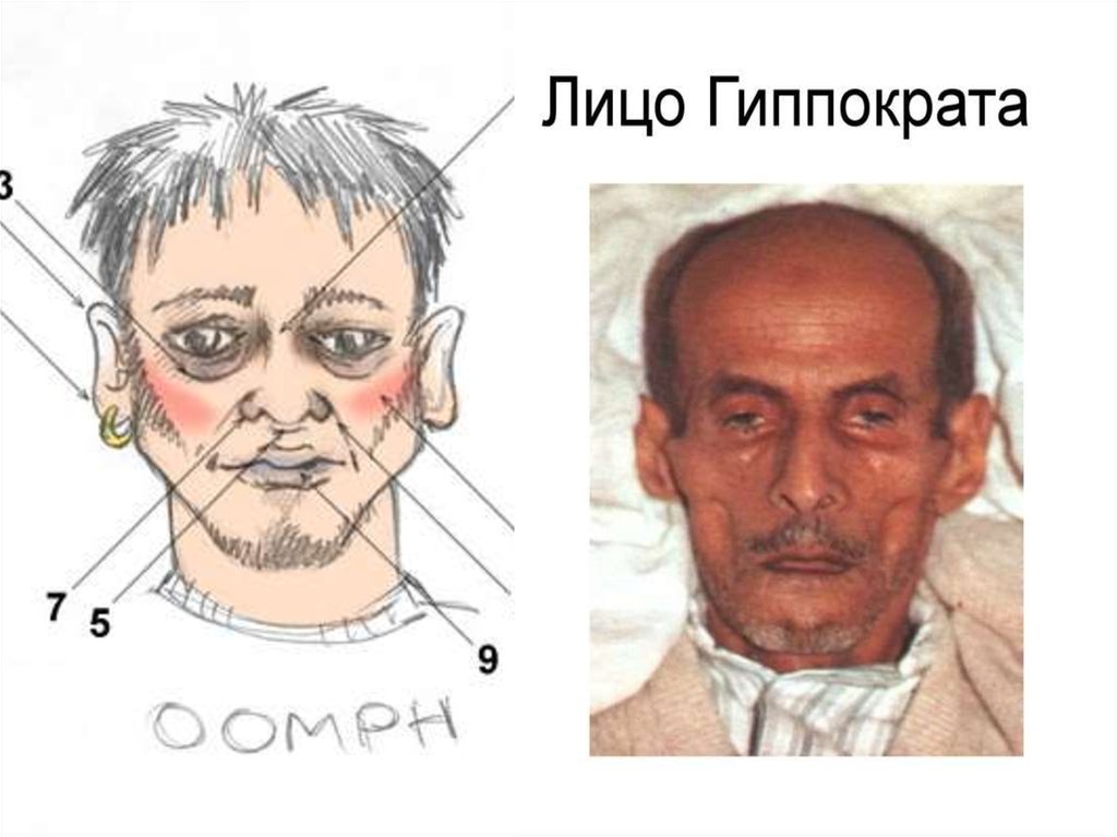 Маска гиппократа перед смертью как выглядит. Холера лицо Гиппократа.