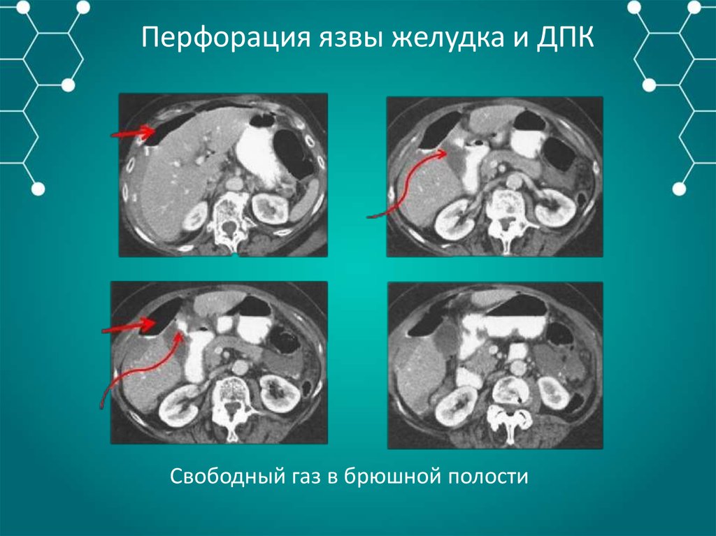 Свободный газ