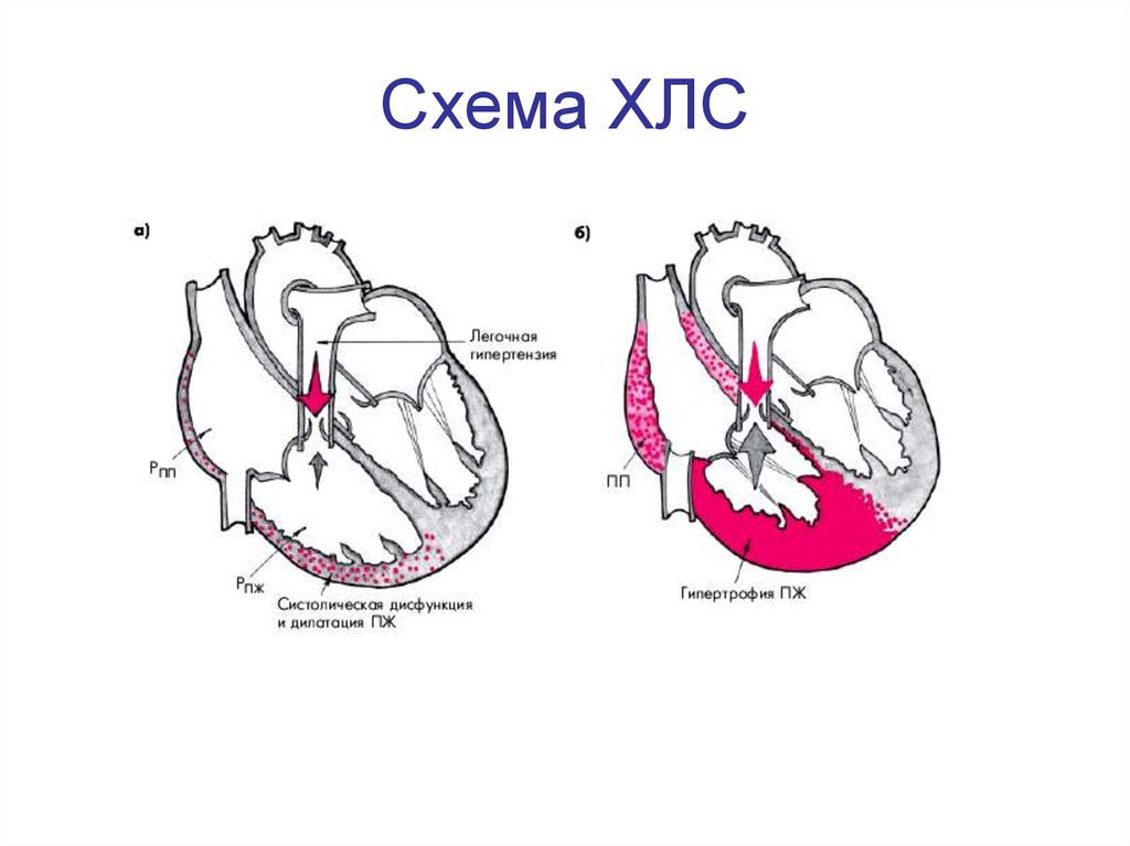 Легочное сердце картинки