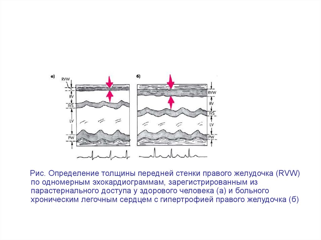 Толщина передней стенке. Толщина передней стенки правого желудочка. Свободная стенка правого желудочка. Коллабирование стенки правого желудочка. Укажите толщину стенки правого желудочка.