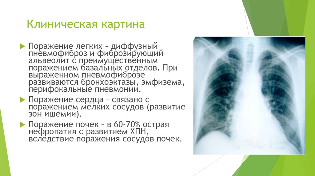 Препараты от фиброза легких. Метапневмонический пневмофиброз что это. Пневмофиброз s5 правого лёгкого. Субплевральный пневмофиброз.