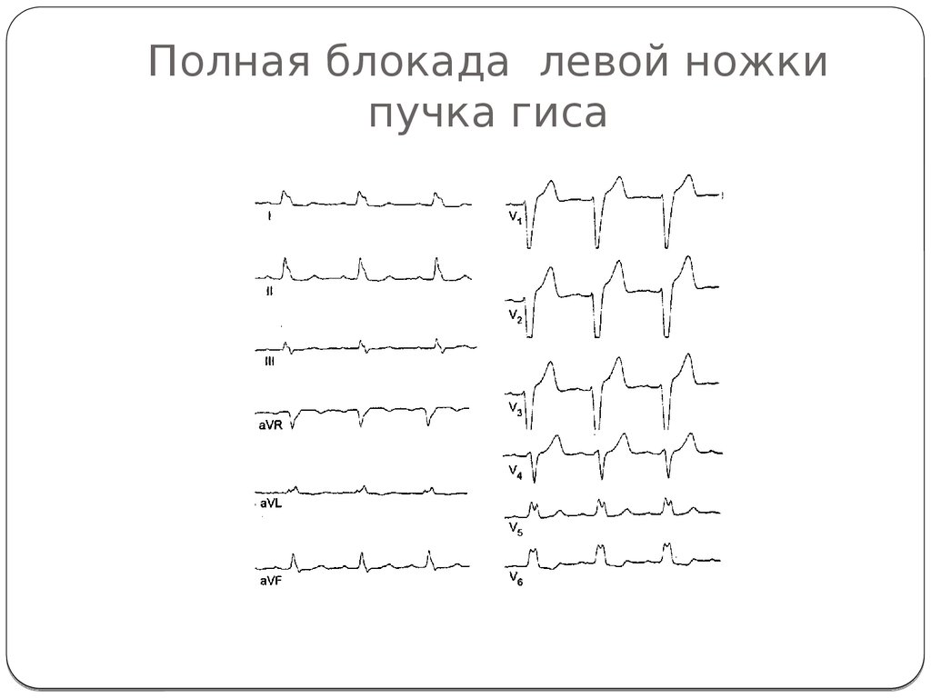 Полная блокада левой ножки