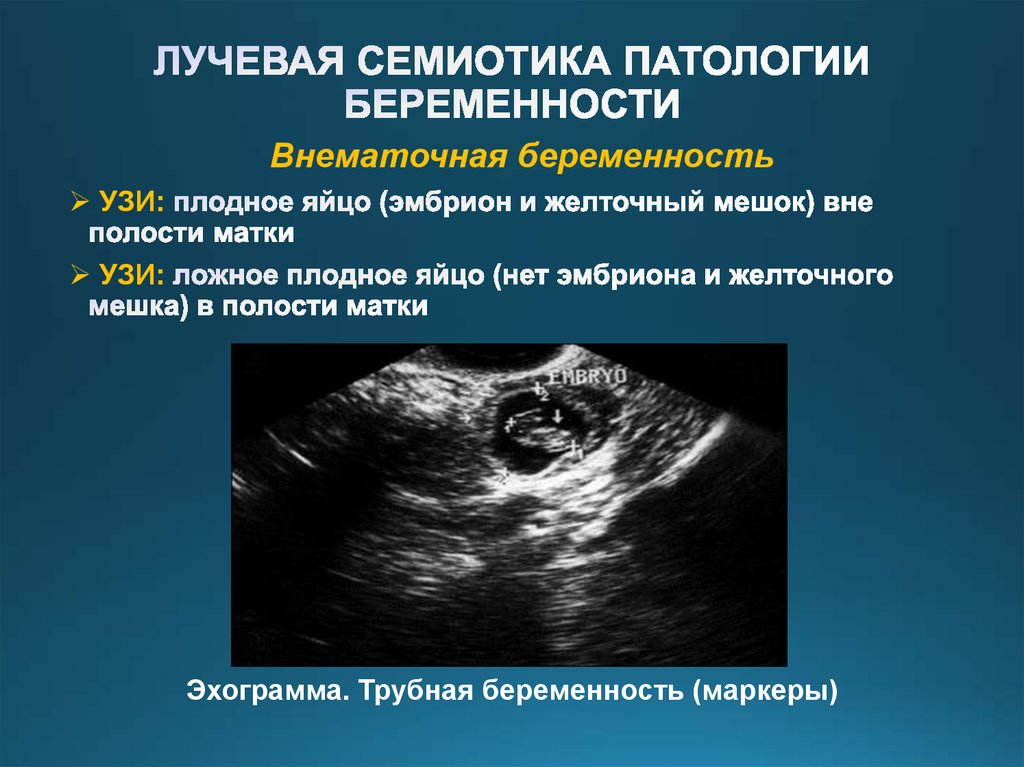 Как отличить внематочную. Внематочная Трубная беременность УЗИ. Внематочная беременность на УЗИ. Трубная беременность УЗИ. УЗИ внематочной беременности на раннем сроке.