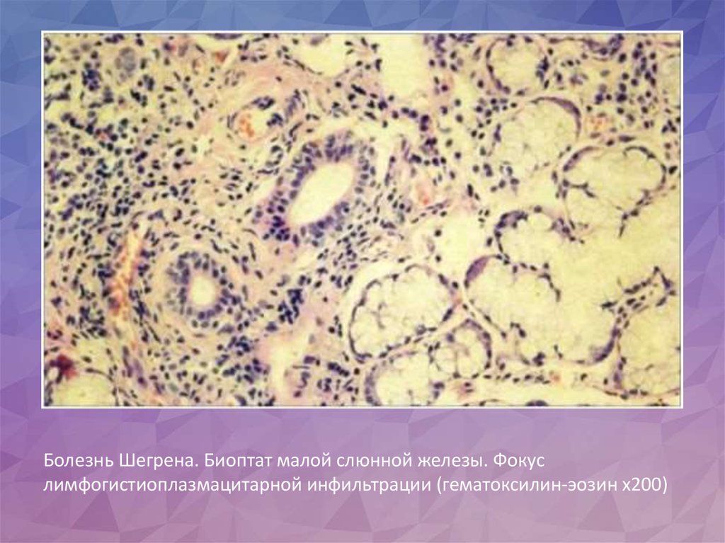 Биоптат. Болезнь Шегрена гистология. Синдром Шегрена патологическая анатомия. Болезнь Микулича гистология. Синдром Микулича гистология.