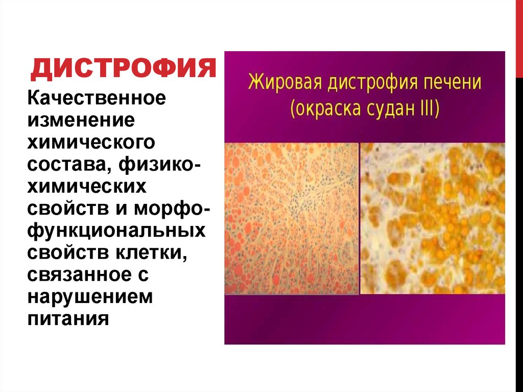 Миотоническая дистрофия