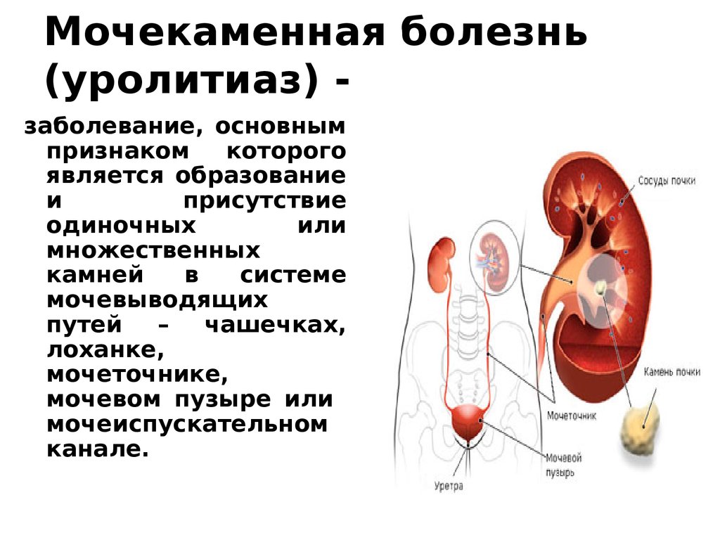 Мочевая колика. Мочекаменная болезнь урология камни мочеточника. Мочекаменная болезнь (уролитиаз). Моче-КАМНЕННАЯ болезнь. Почечнокаменная болезнь.