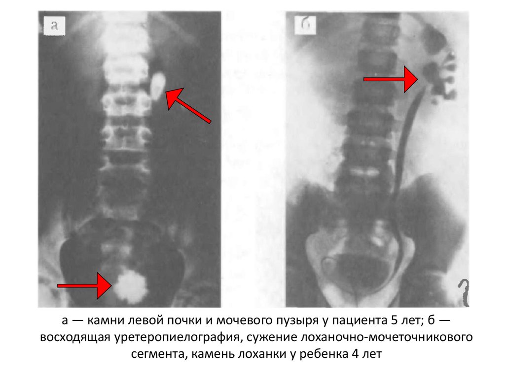 Левая почка. Ретроградная уретеропиелография камень. Что такое конкремент лоханочно-мочеточникового сегмента. Конкремент левой почки.