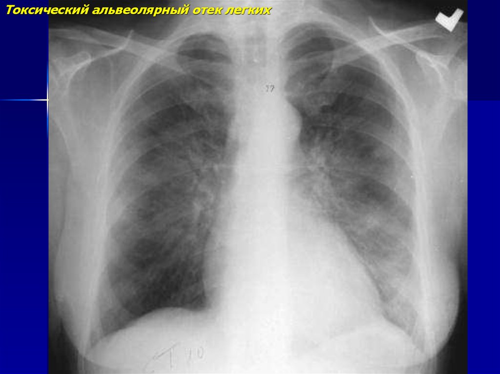 Токсический отек легких. Реэкспансивный отек легкого. Интраальвеолярный отек легких. Альвеолярный отек рентген.