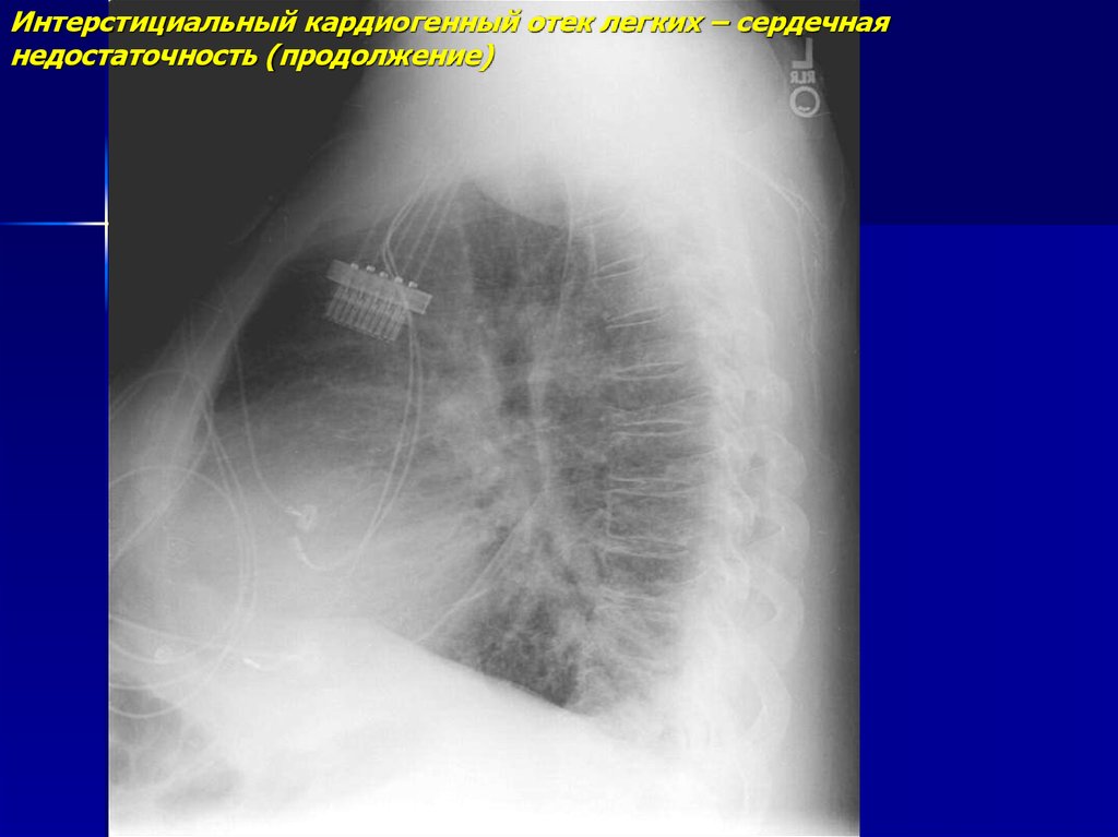 Кардиогенный отек. Кардиогенный отек легких. Интерстициальный отек легких. Интерстициальный отек лёгких. Кардиогенный отек рентген.